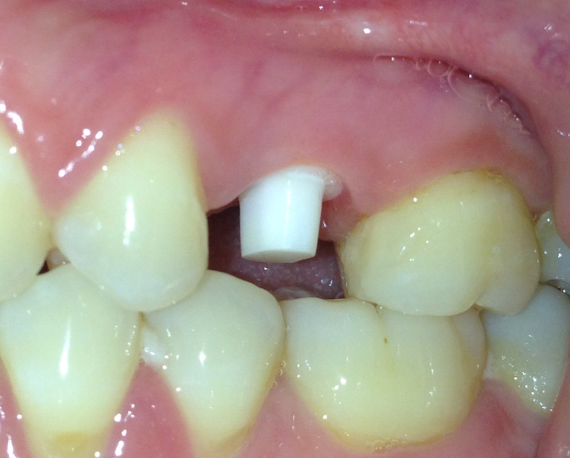 Zirconia implants Sofia