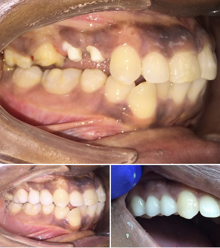 Zirconia implants Sofia